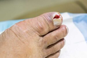 ingrown toenail painful infection