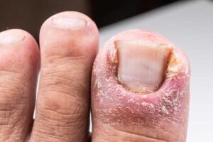painful inflammed infection