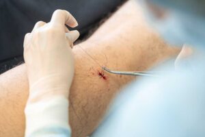 Laceration-Repair-and-Scar-Minimization